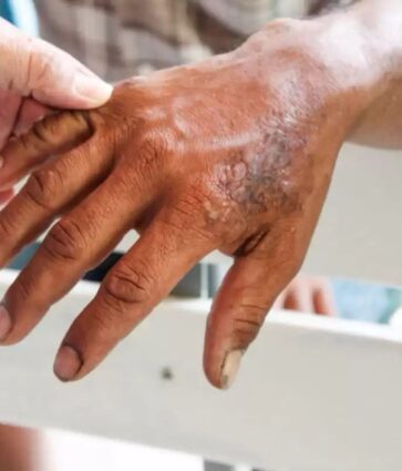 México: Programa Nacional de Eliminación de Lepra fortalece tratamientos gratuitos en el país