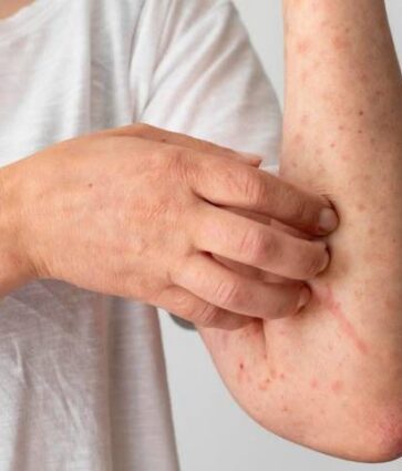 Salud emite “aviso” epidemiológico por 140 casos probables de sarampión o rubéola